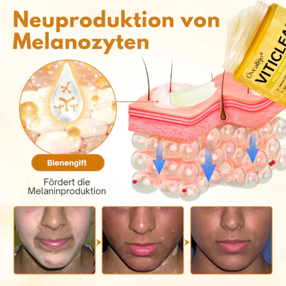 Oveallgo® VitiClear Pro Hautpflegecreme – 90% effektive Linderung bei Vitiligo