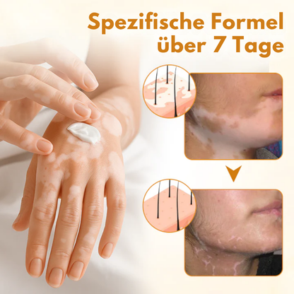 Oveallgo® VitiClear Pro Hautpflegecreme – 90% effektive Linderung bei Vitiligo