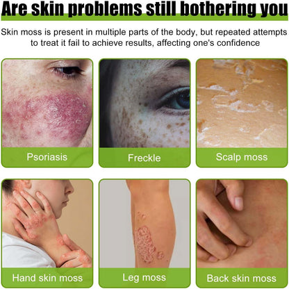 Todahof Bienengift-Psoriasis-Behandlungscreme, Todahof Bienengift-Psoriasis-Behandlungscreme, Todahof Bienengift-Creme, Psoriasis-Creme, Bienengift-Psoriasis-Behandlungscreme (3 Stück)