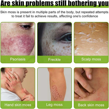 Todahof Bienengift Psoriasis Behandlungscreme, Todahof Bienengift Psoriasis Behandlungscreme, Todahof Bienengift Creme, Psoriasis Creme, Bienengift Psoriasis Behandlungscreme (3 Stück)