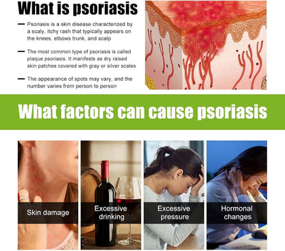 Todahof Bienengift-Psoriasis-Behandlungscreme, Todahof Bienengift-Psoriasis-Behandlungscreme, Todahof Bienengift-Creme, Psoriasis-Creme, Bienengift-Psoriasis-Behandlungscreme (3 Stück)