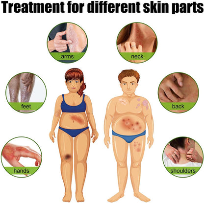 Todahof Bienengift-Psoriasis-Behandlungscreme, Todahof Bienengift-Psoriasis-Behandlungscreme, Todahof Bienengift-Creme, Psoriasis-Creme, Bienengift-Psoriasis-Behandlungscreme (3 Stück)