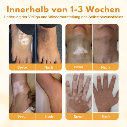Oveallgo® VitiClear Pro Hautpflegecreme – 90% effektive Linderung bei Vitiligo