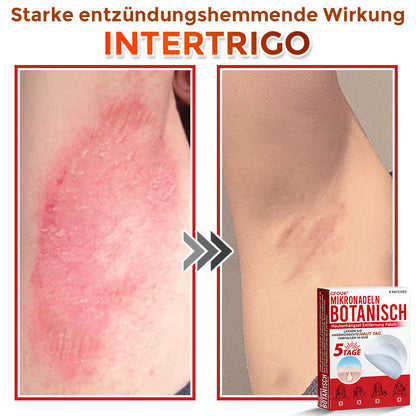 GFOUK® Mikronadeln Botanisch Hautanhängsel Entfernung Patch 🇩🇪 Hergestellt in Deutschland