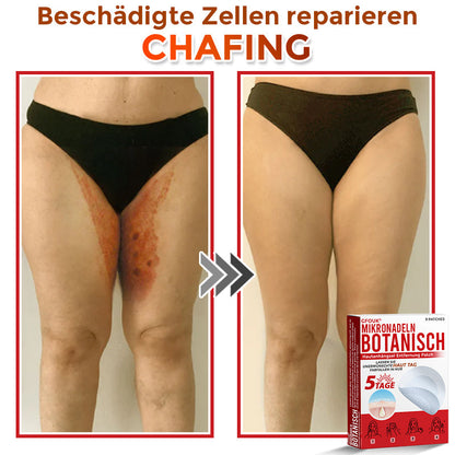 GFOUK® Mikronadeln Botanisch Hautanhängsel Entfernung Patch 🇩🇪 Hergestellt in Deutschland