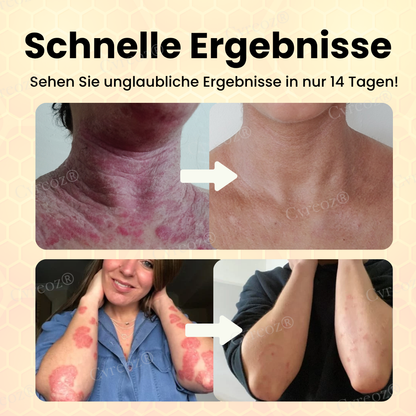 Cvreoz® Bienengift Psoriasis Behandlung Creme