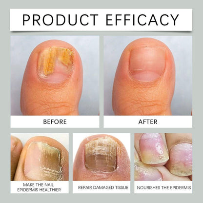 Furzero™ - SOUTH MOON🌟 Bienengift Nagelpilzbehandlung: Eine Komplettlösung für Nagelpilz